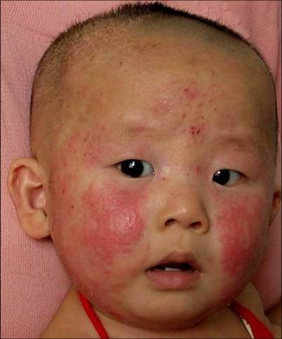 宝宝湿疹治疗 湿疹治疗不可滥用药