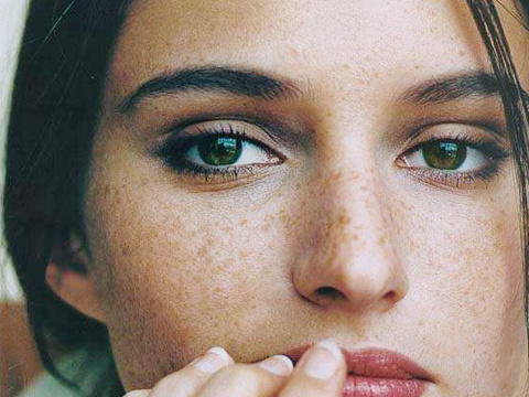 遗传斑怎么治 遗传性雀斑怎么去除最有效