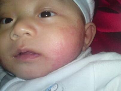 宝宝起热痱子怎么办 厨房里有良药治疗小儿热痱子