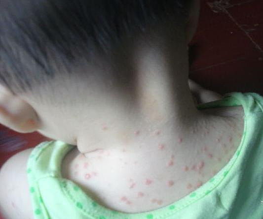 婴儿痱子的治疗方法以及防痱的食疗方