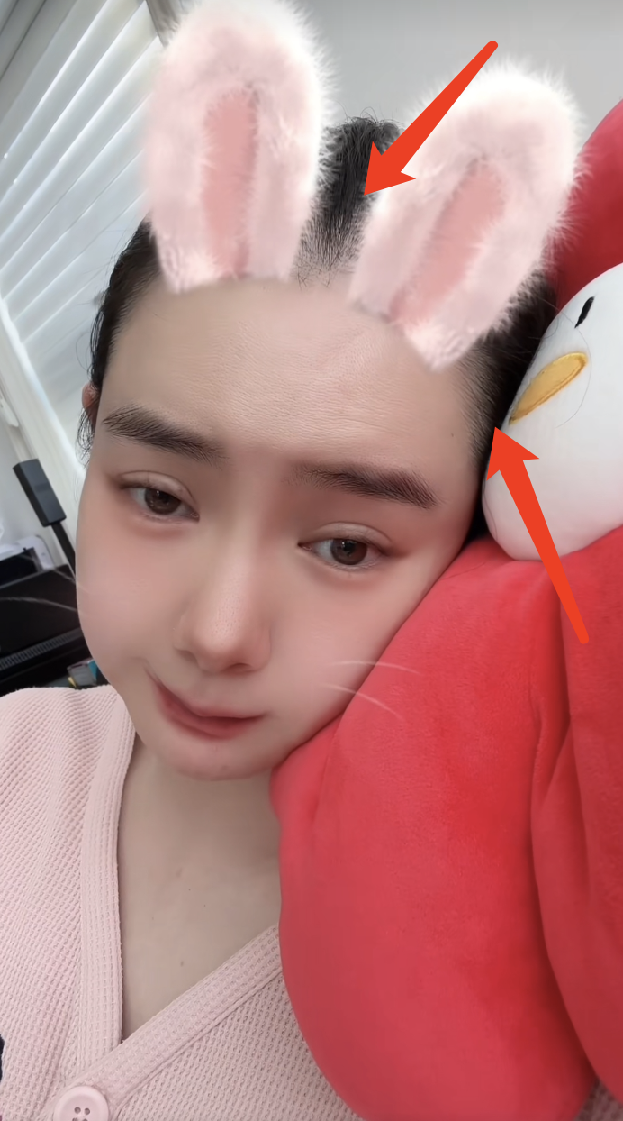 戚薇二胎产后未瘦至90斤压力大,脱发严重头皮抢镜,发际线上移