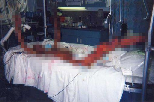 大内久83天活体腐烂图片